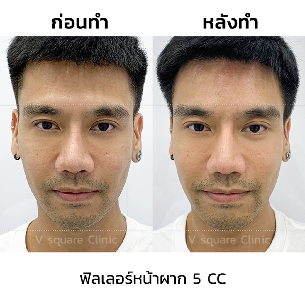 รีวิว ฟิลเลอร์หน้าผาก_2
