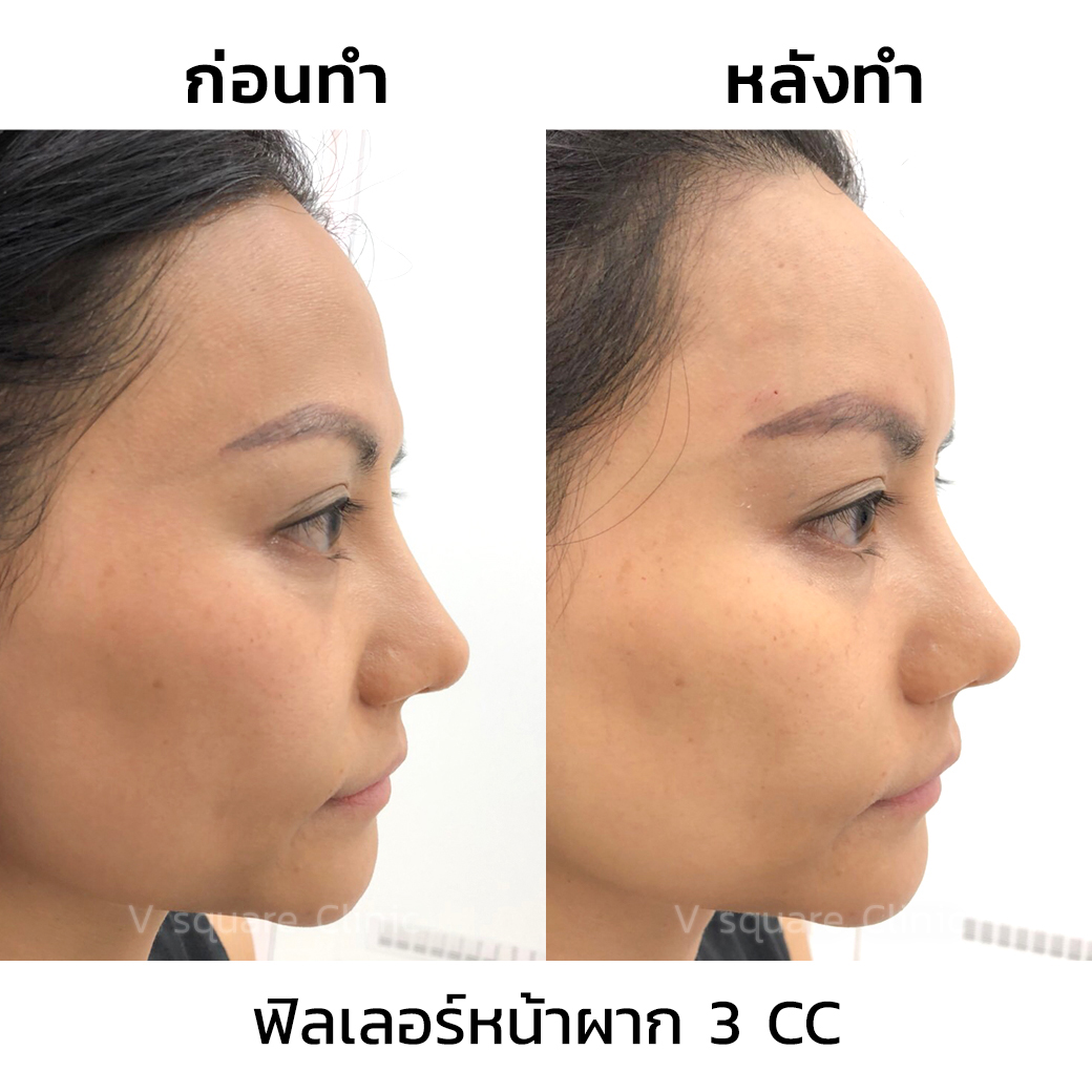 รีวิว ฟิลเลอร์หน้าผาก_3