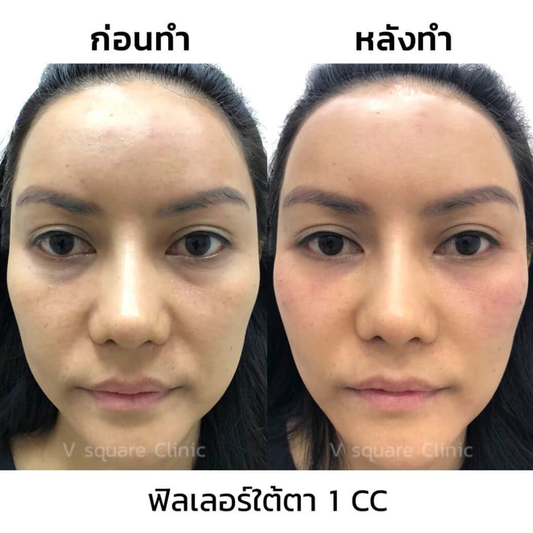 รีวิว ฟิลเลอร์หน้าผาก_4