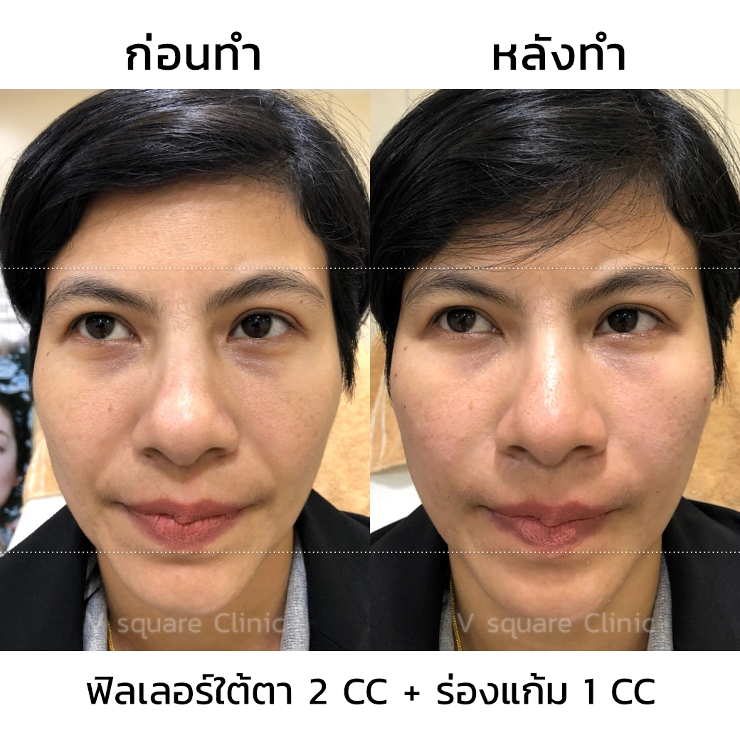 รีวิว ฟิลเลอร์ใต้ตา_1