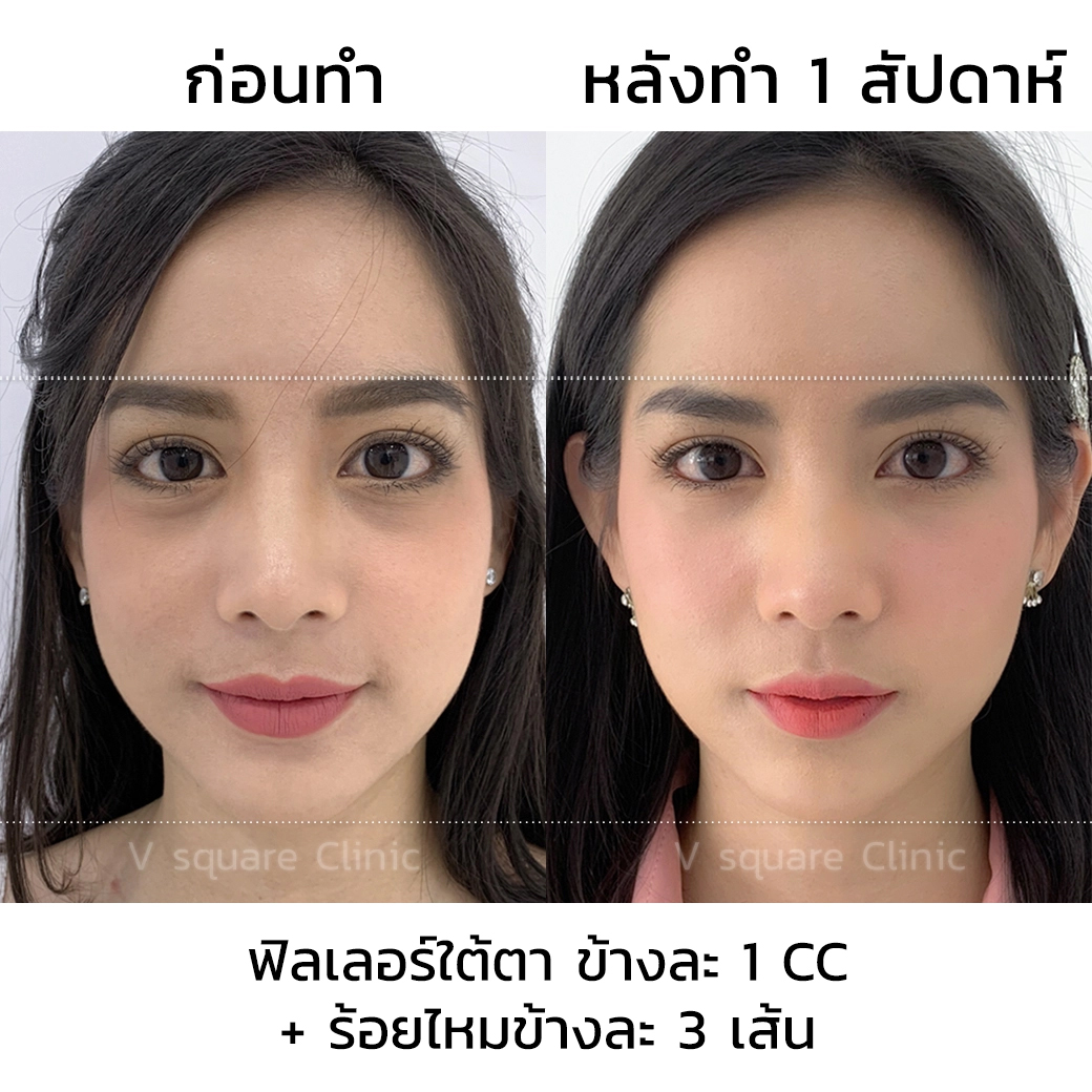 รีวิว ฟิลเลอร์ใต้ตา_3