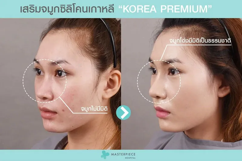 รีวิว เสริมจมูกซิลิโคนเกาหลี