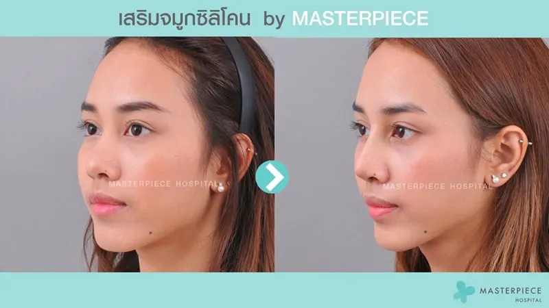 รีวิว เสริมจมูกซิลิโคนเกาหลี