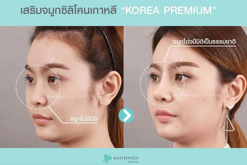 รีวิว เสริมจมูกซิลิโคนเกาหลี