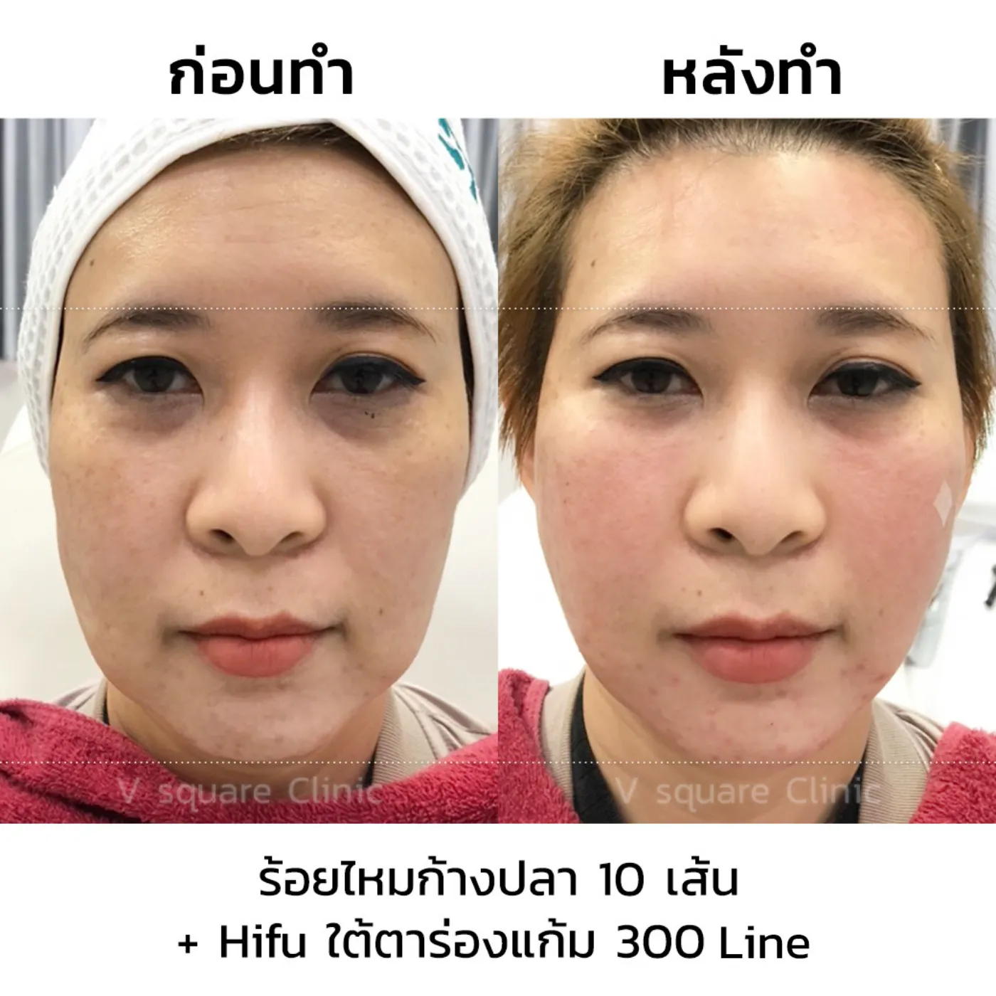 รีวิวร้อยไหมก้างปลา 10 เส้น