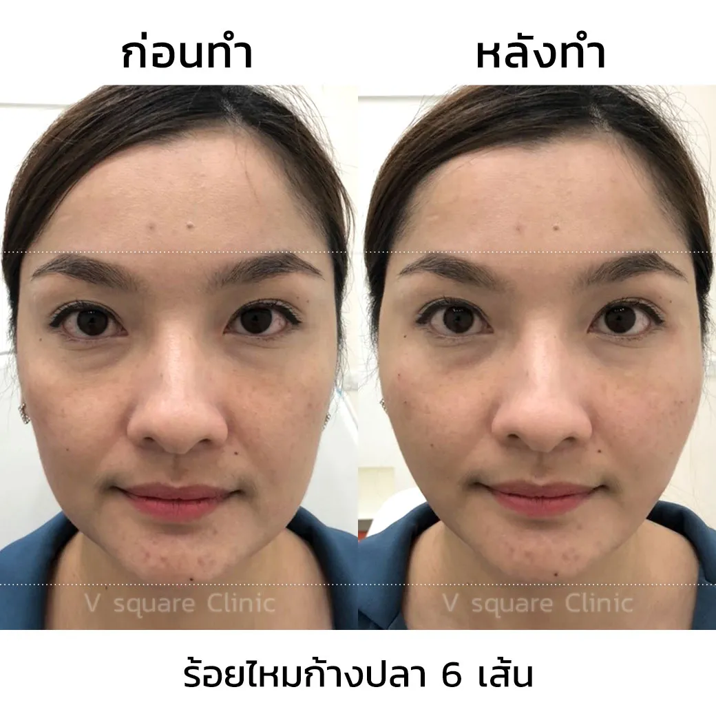 รีวิวร้อยไหมก้างปลา 6 เส้น