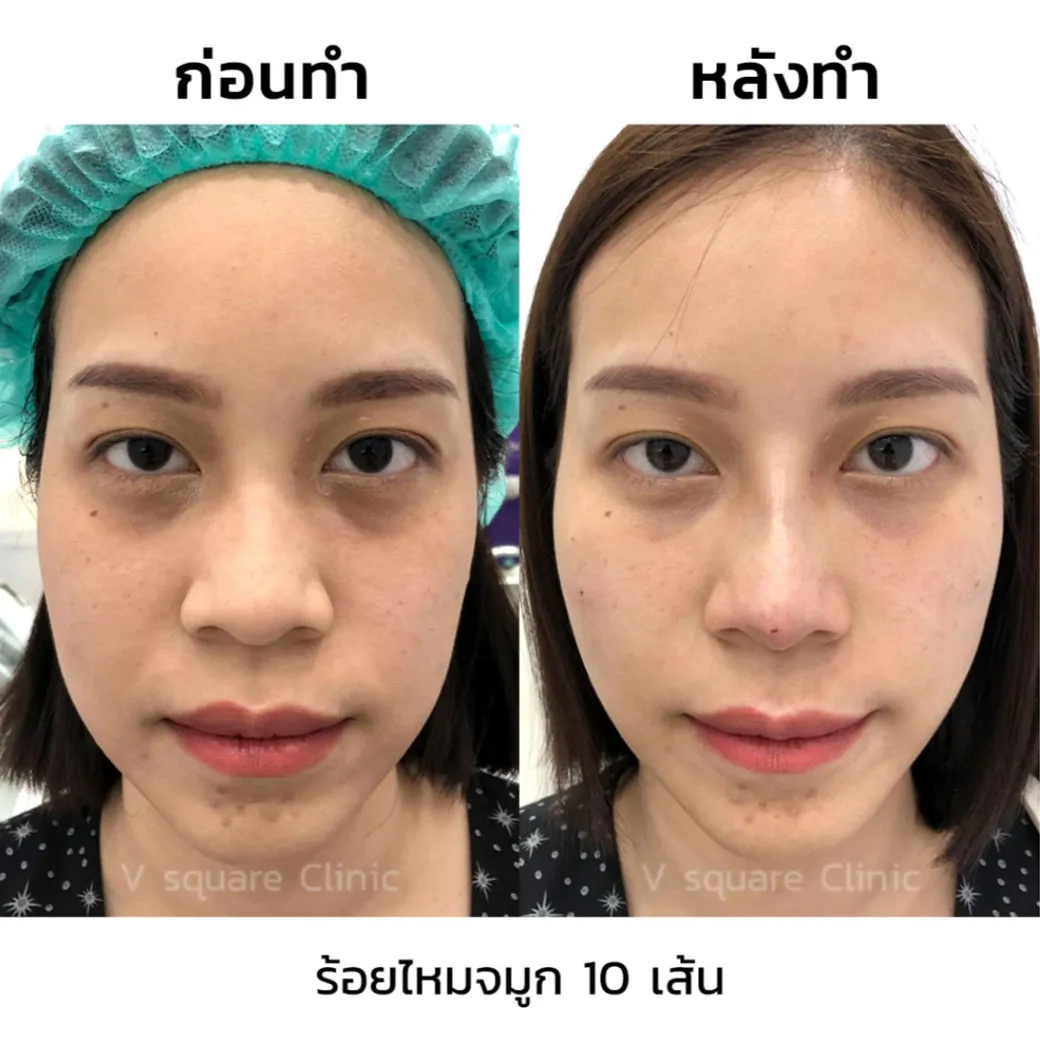 รีวิวร้อยไหมก้างปลา ร้อยไหมจมูก