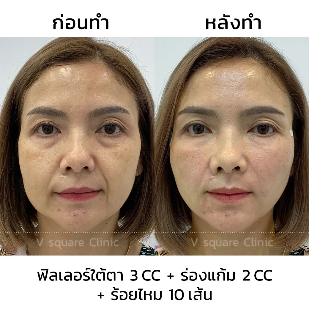 รีวิวร้อยไหมก้างปลา+ฟิลเลอร์ร่องแก้ม