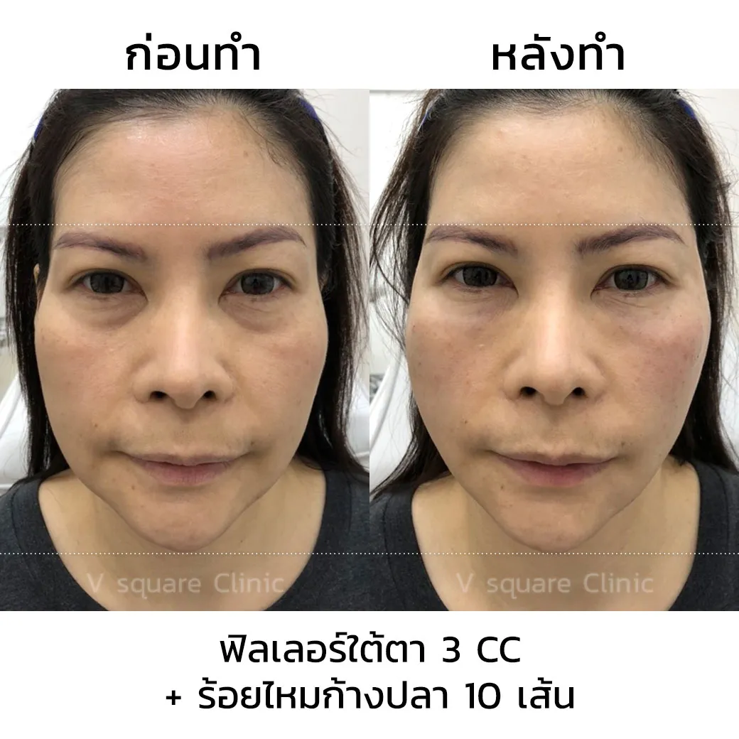 รีวิวร้อยไหมก้างปลา+ฟิลเลอร์ใต้ตา