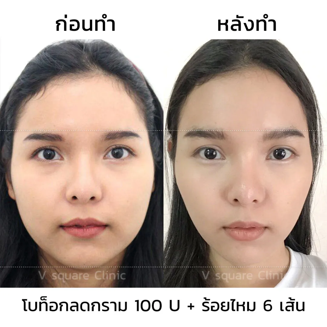 รีวิวร้อยไหมก้างปลา+โบท็อก