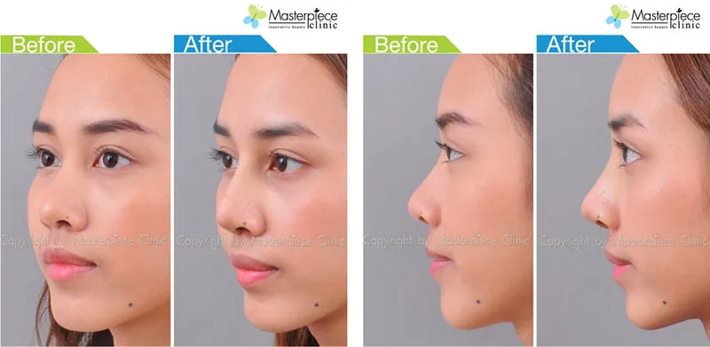 รีวิวเสริมจมูกซิลิโคน_2