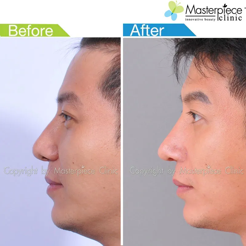 รีวิวเสริมจมูกแบบโอเพ่น_1