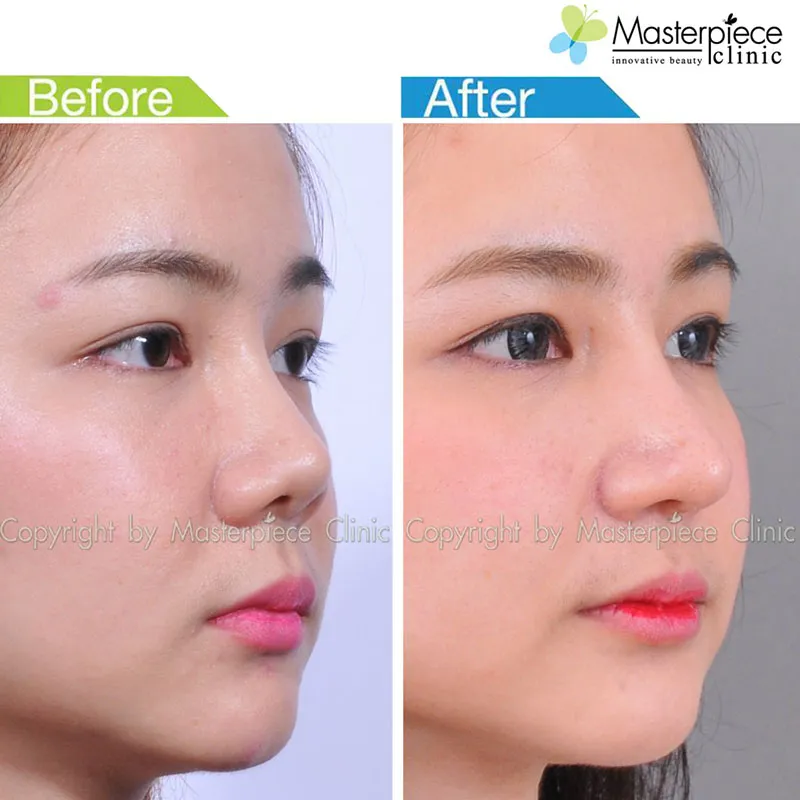 รีวิวเสริมจมูกแบบโอเพ่น_3