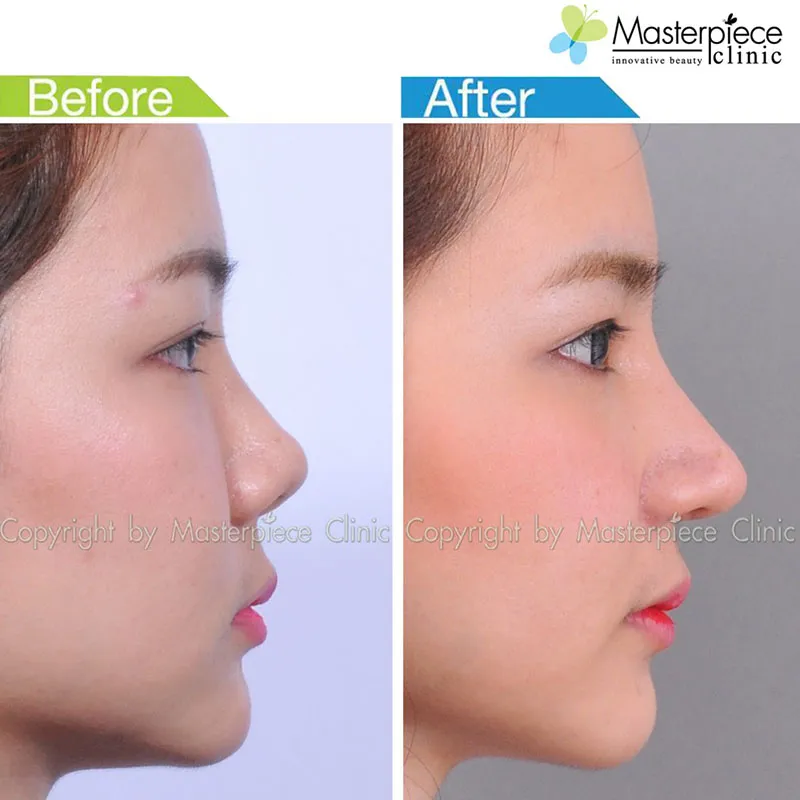รีวิวเสริมจมูกแบบโอเพ่น_4