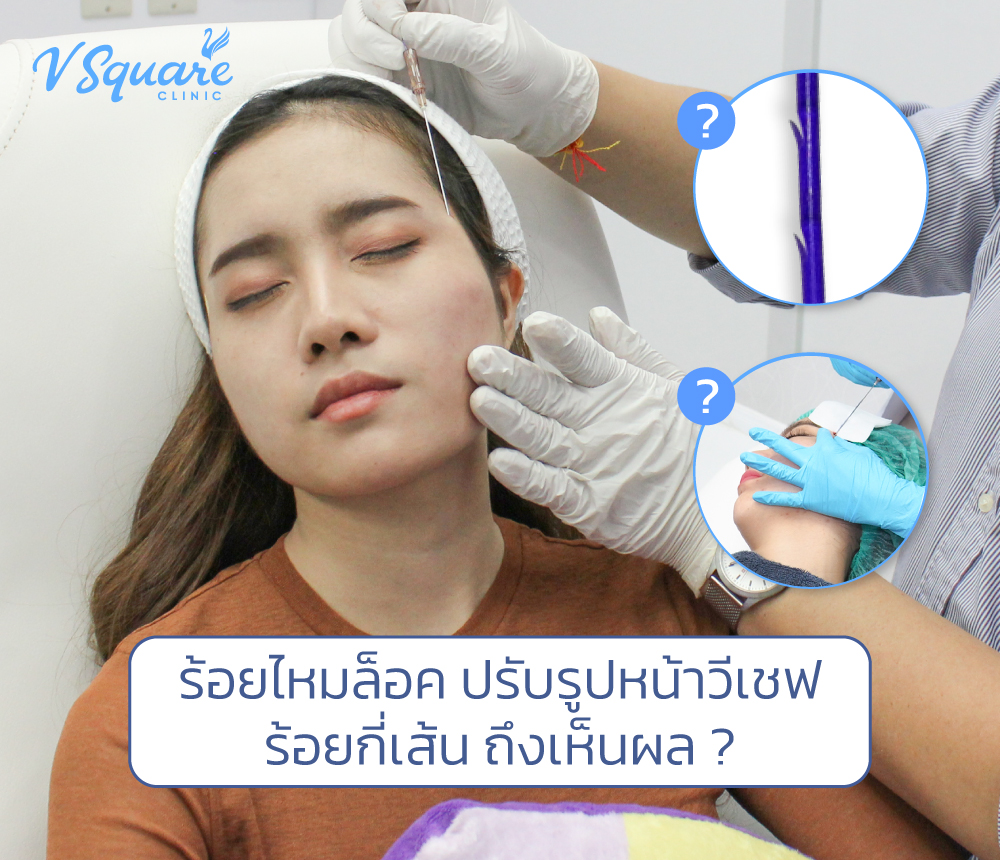 ร้อยไหมล็อค