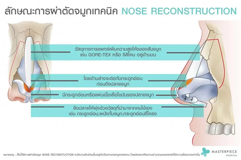 เทคนิคเสริมจมูก Nose Reconstruction