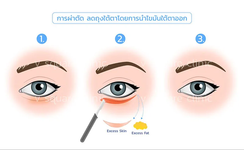 การผ่าตัด-ลดถุงใต้ตา