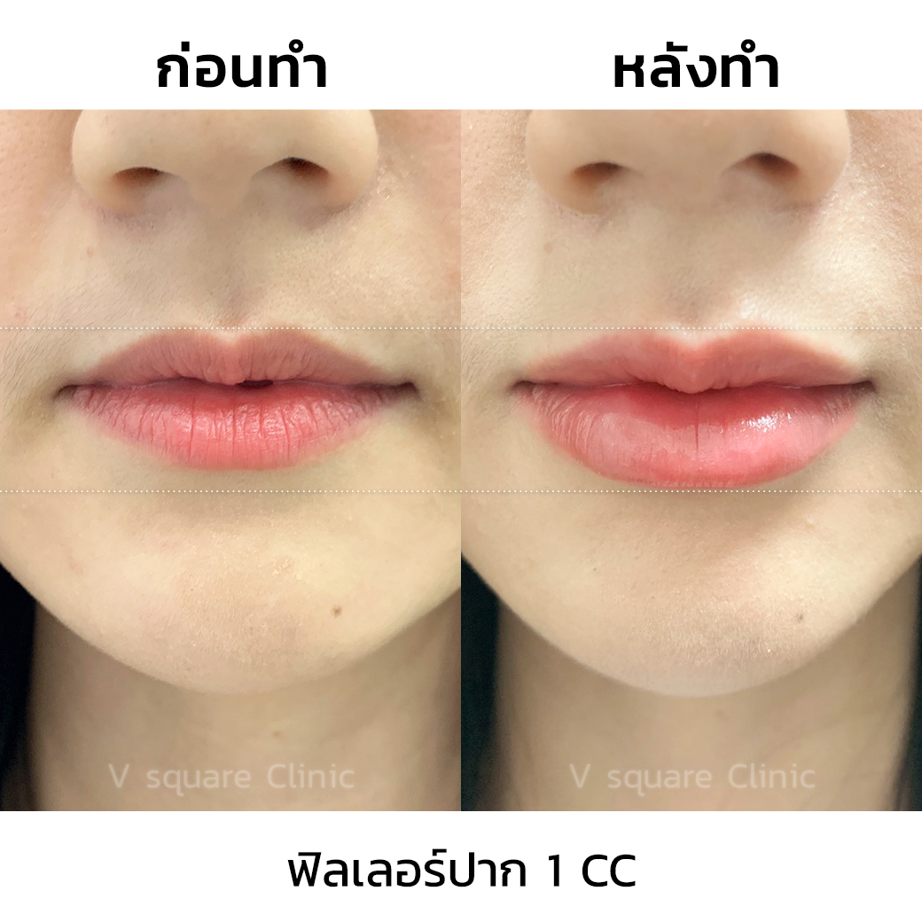 รีวิวฟิลเลอร์ปาก