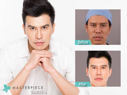 รีวิวเสริมจมูกเทคนิค Nose Reconstruction