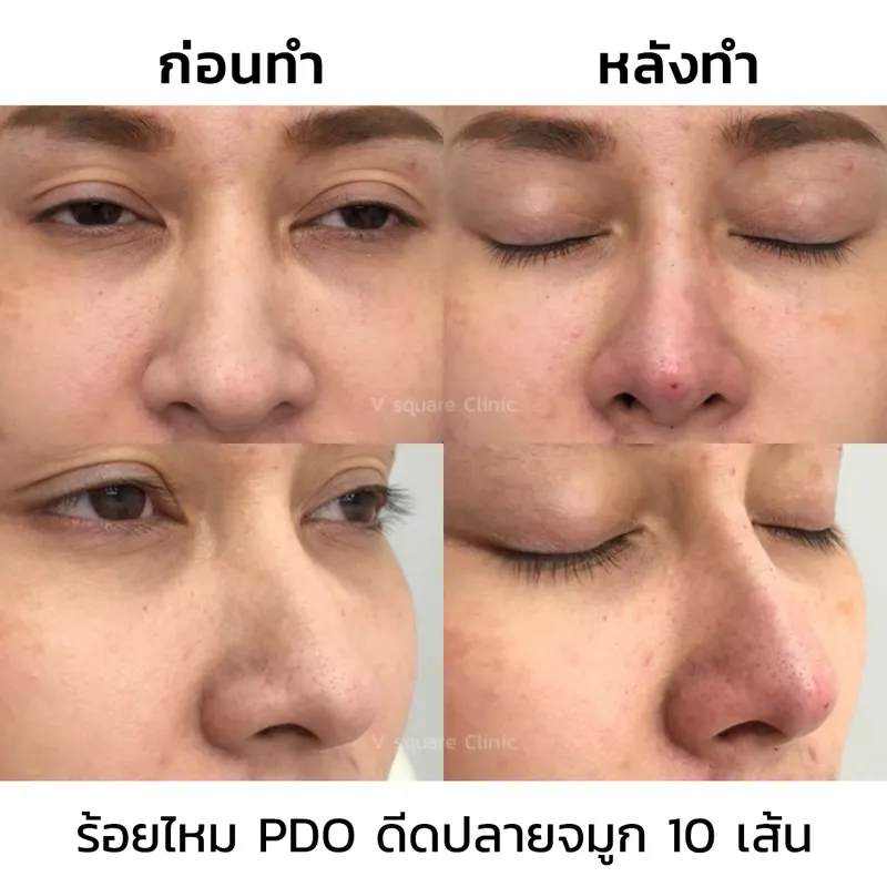 ร้อยไหมจมูก ช่วยเสริมดั้งโด่ง จมูกสวยดีดปลายแบบไม่ต้องผ่าตัด ร้อยไหมจมูก ช่วยเสริมดั้งโด่ง จมูกสวยดีดปลายแบบไม่ต้องผ่าตัด
