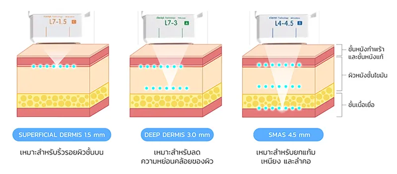 New Ulthera SPT