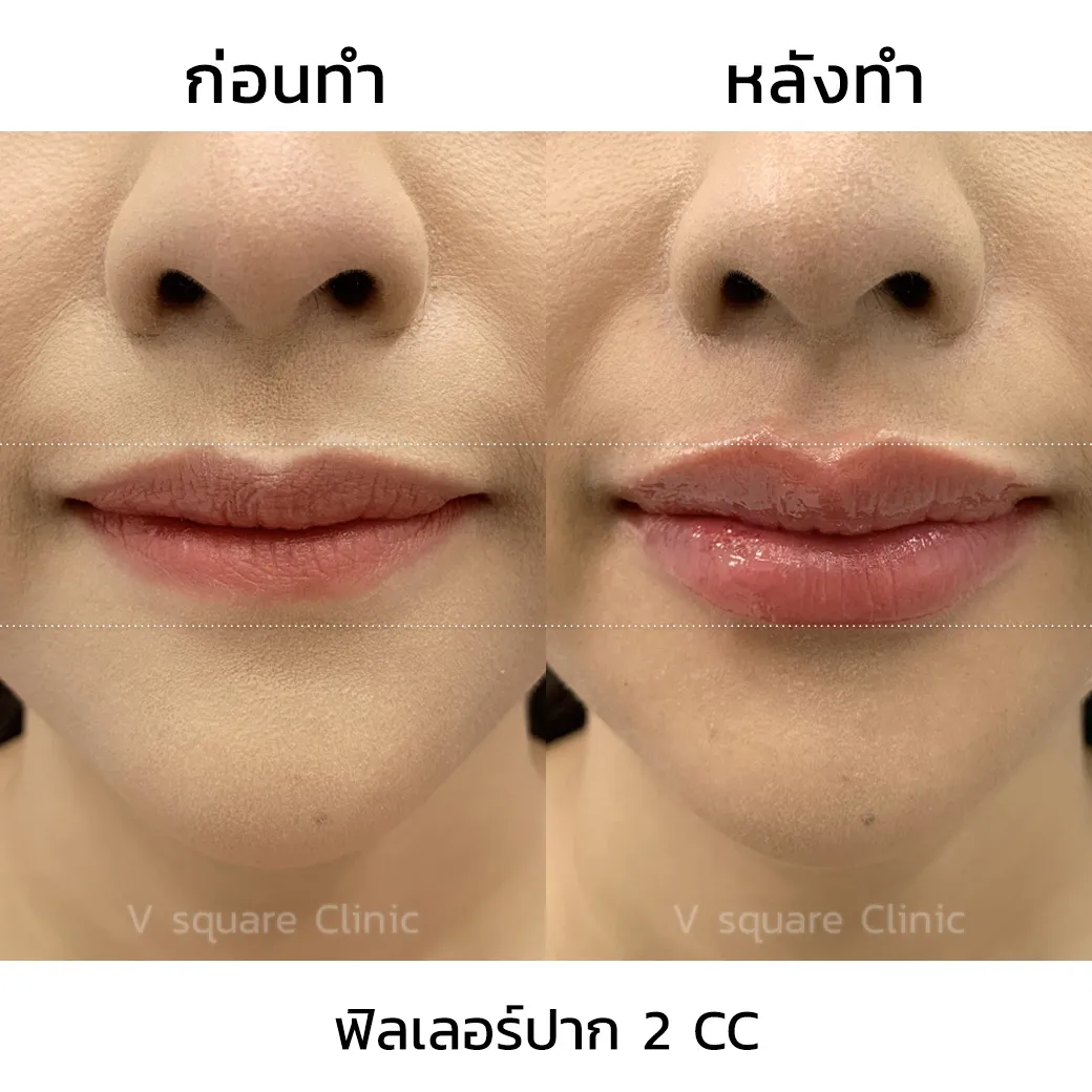 ฟิลเลอร์ Restylane Kysse รีวิว1