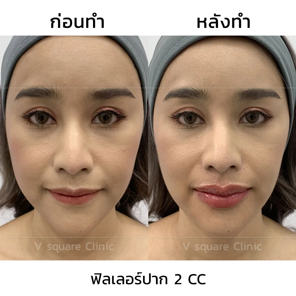 ฟิลเลอร์ Restylane Kysse รีวิว2