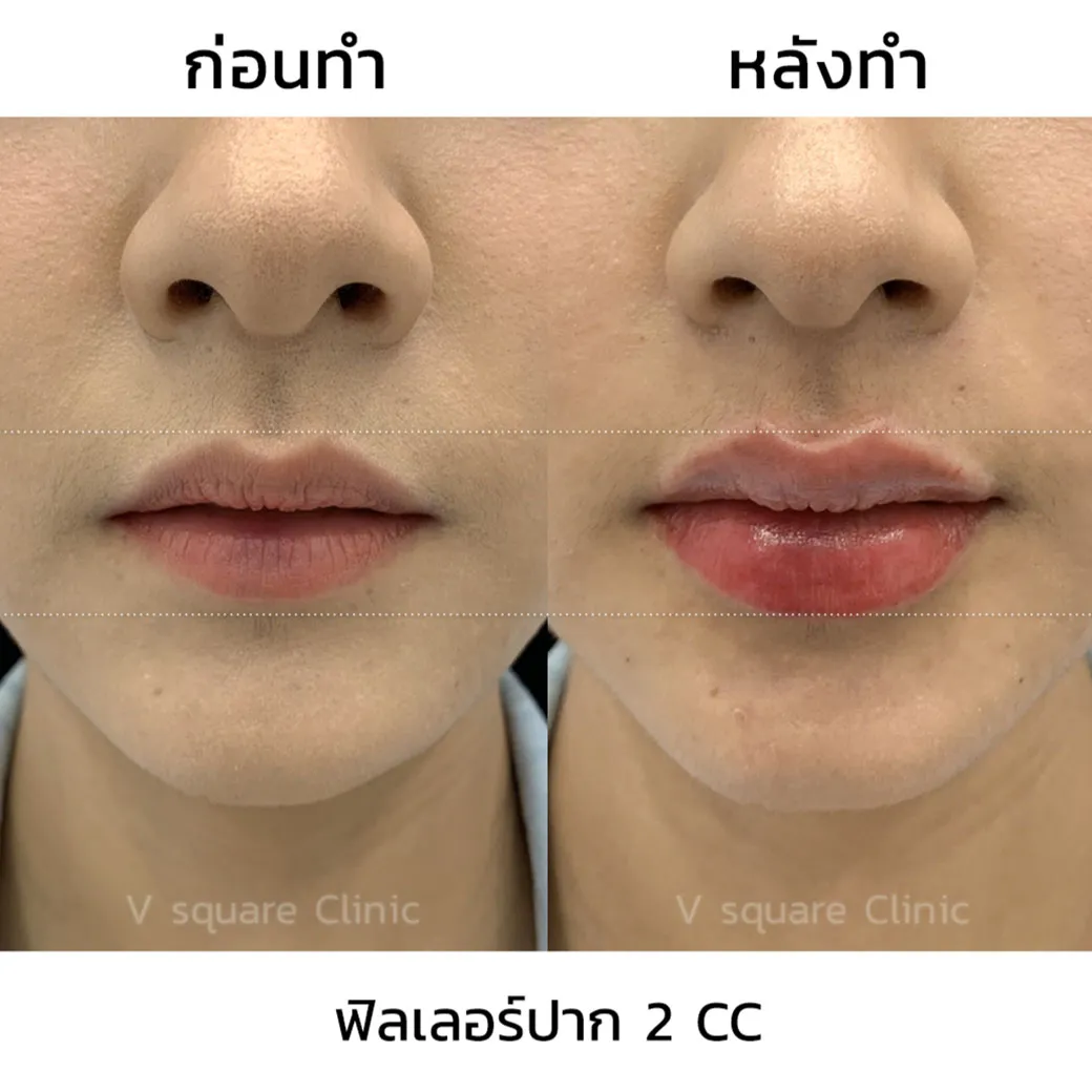 ฟิลเลอร์ Restylane Kysse รีวิว3