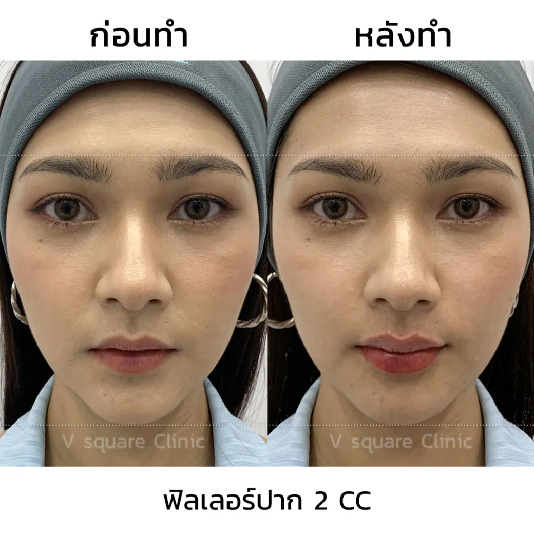 ฟิลเลอร์ Restylane Kysse รีวิว4