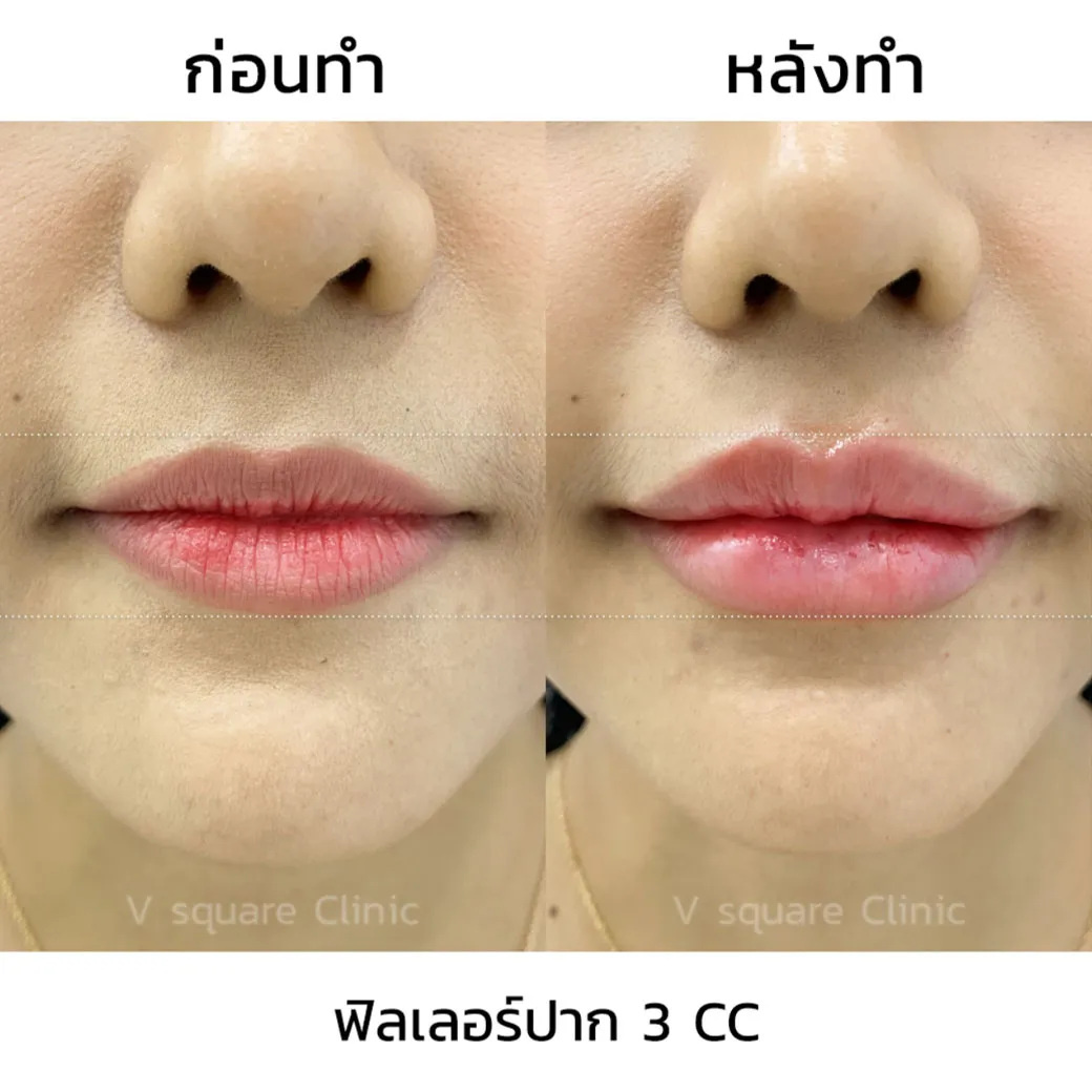 ฟิลเลอร์-Restylane-Kysse-รีวิว5