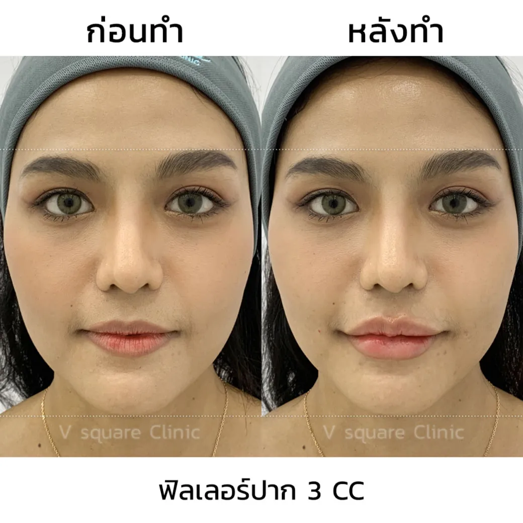 ฟิลเลอร์-Restylane-Kysse-รีวิว6