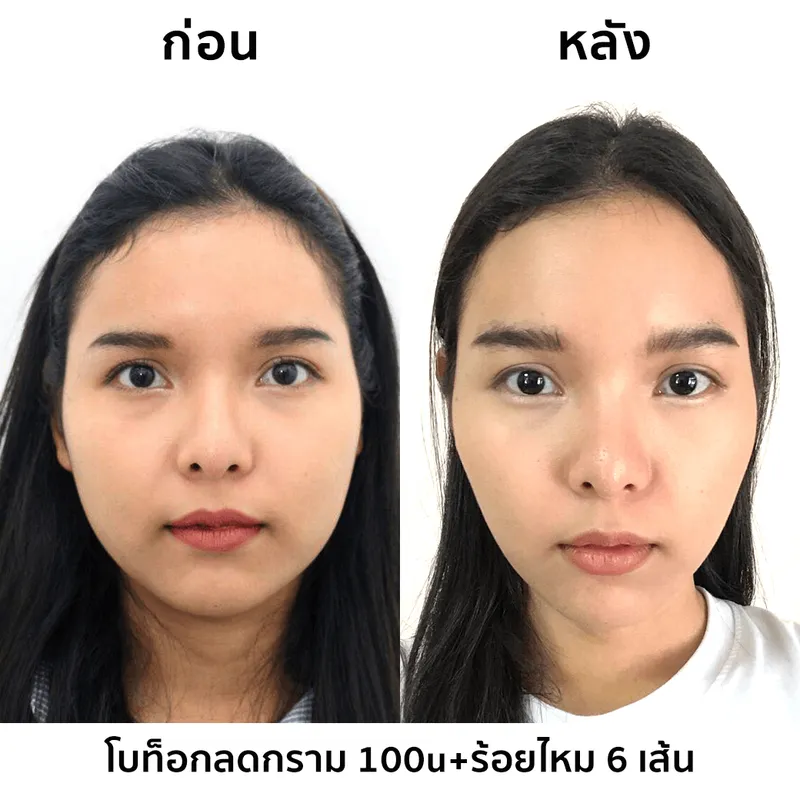 รีวิวฉีดโบท็อกลดกราม ปรับหน้าเรียว 100u + ร้อยไหม 6 เส้น