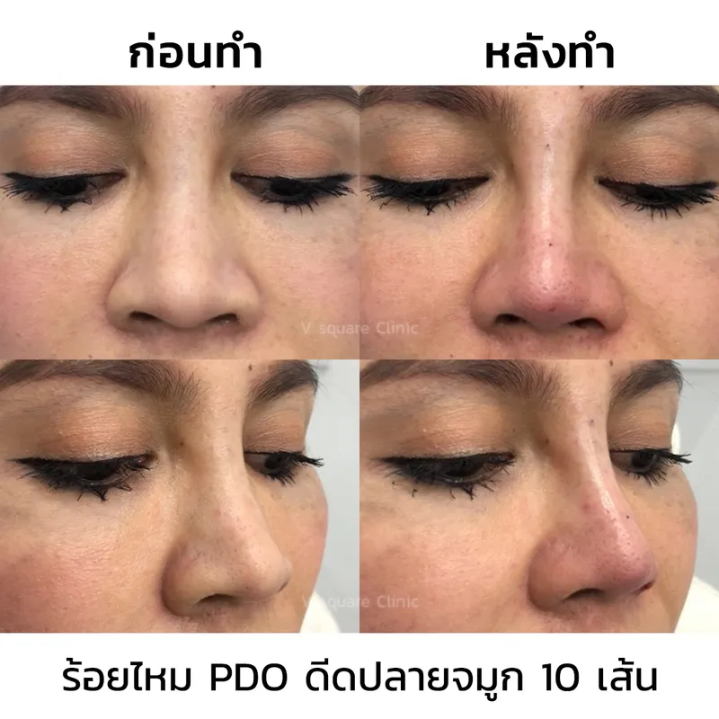 รีวิวร้อยไหมเก็บปีกจมูก ดีดปลายจมูก 10 เส้น_2