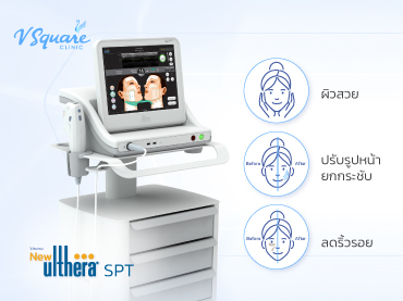 Ultheraยกกระชับลิดริ้วรอย