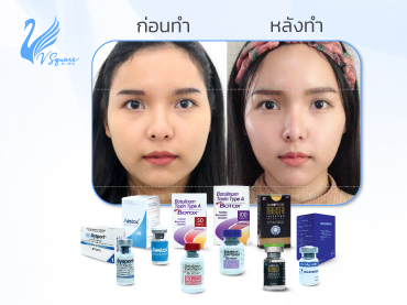 ฉีดโบท็อกซ์กี่วันเห็นผล_รีวิวปรับรูปหน้า_