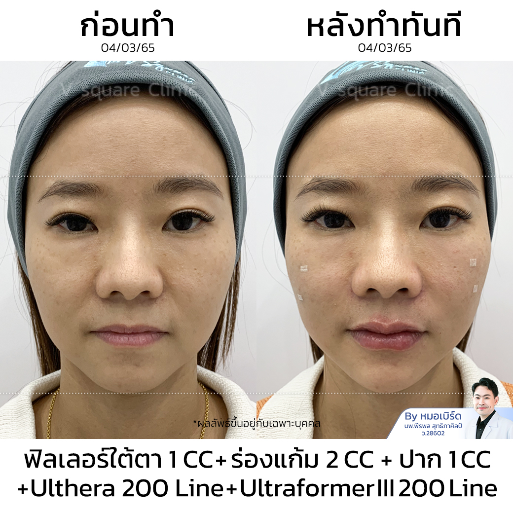 รีวิว Ulthera