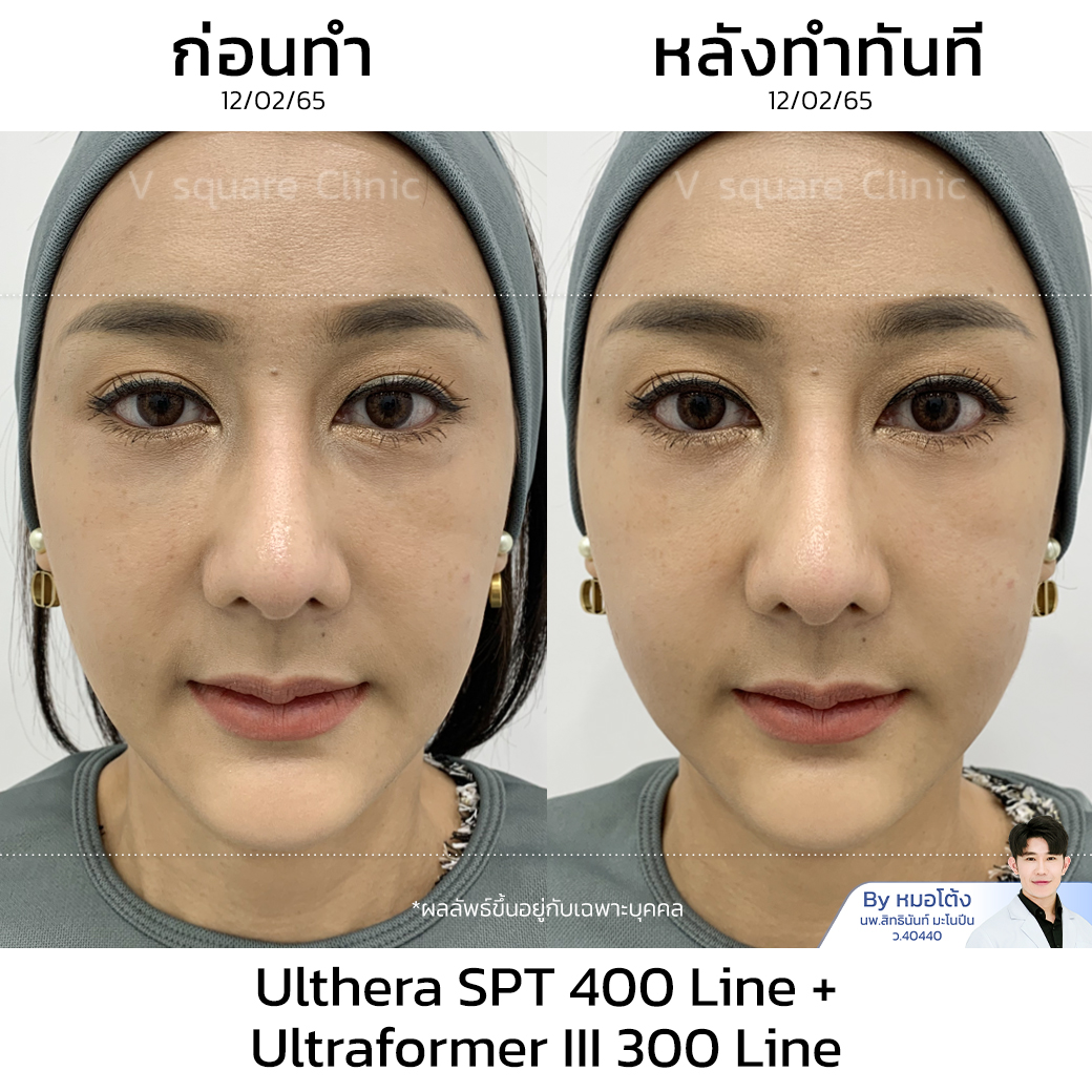 รีวิว Ulthera