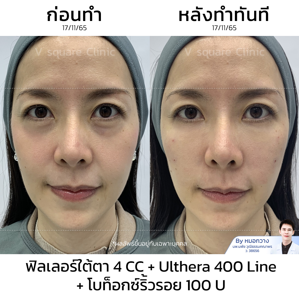 รีวิว Ulthera_3