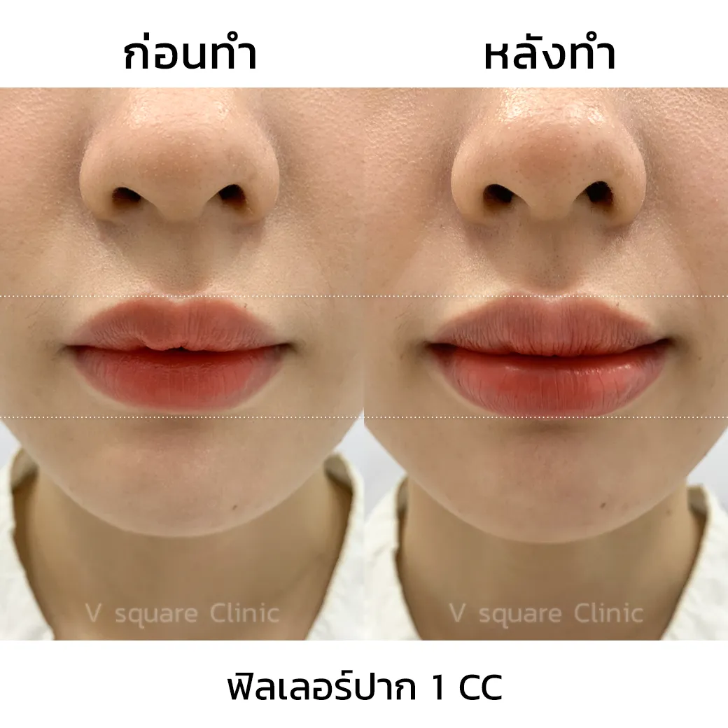 รีวิวฉีดปากเกาหลี 1 cc_9
