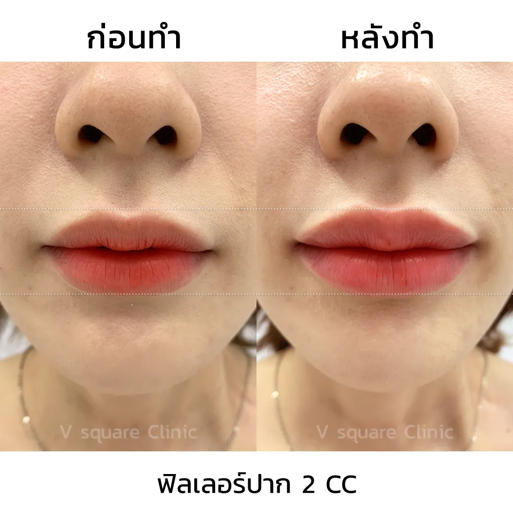 รีวิวฉีดปากเกาหลี 2 cc_7