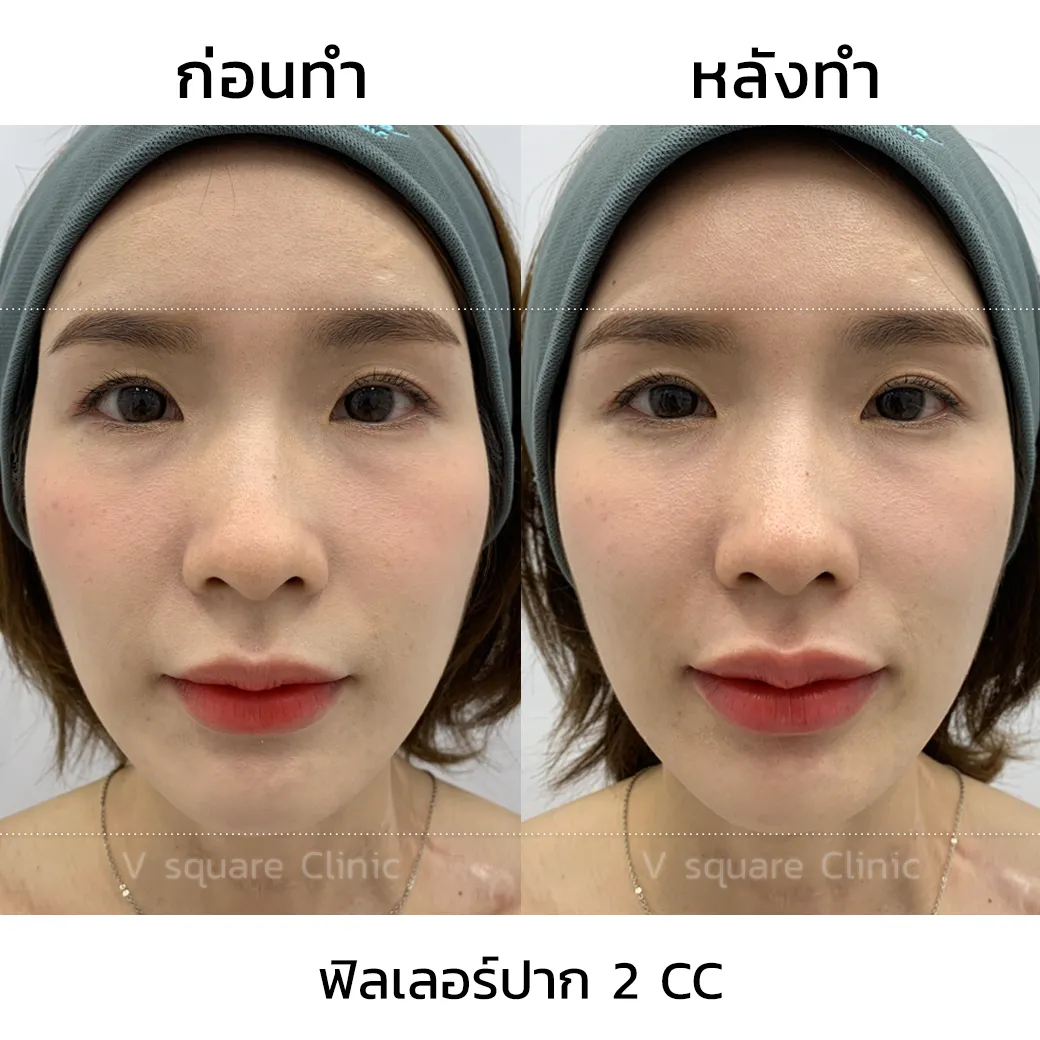รีวิวฉีดปากเกาหลี 2 cc_8