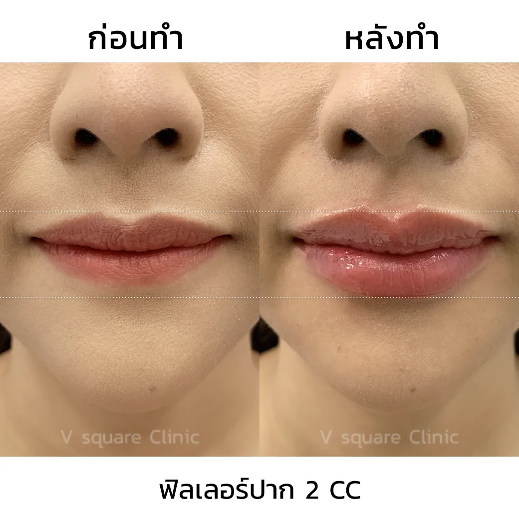 รีวิวฉีดปากเกาหลี 2cc_1