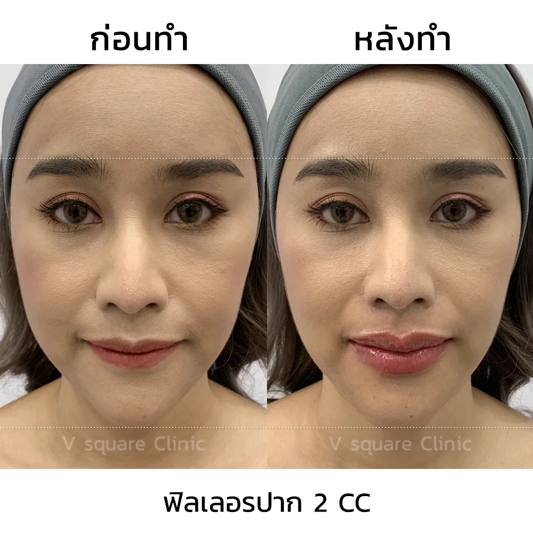 รีวิวฉีดปากเกาหลี 2cc_2
