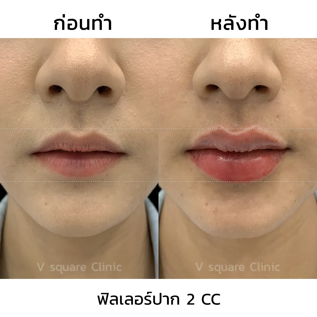 รีวิวฉีดปากเกาหลี 2cc_3