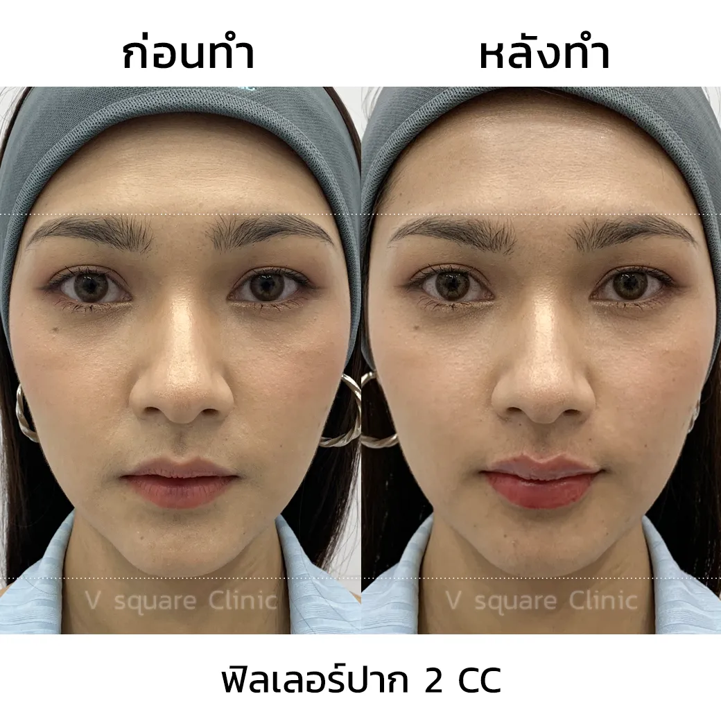 รีวิวฉีดปากเกาหลี 2cc_4