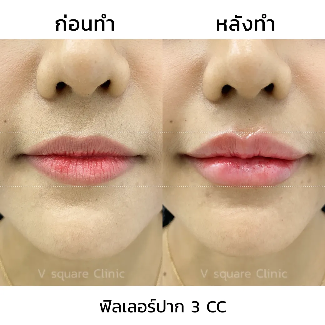 รีวิวฉีดปากเกาหลี 3 cc_5