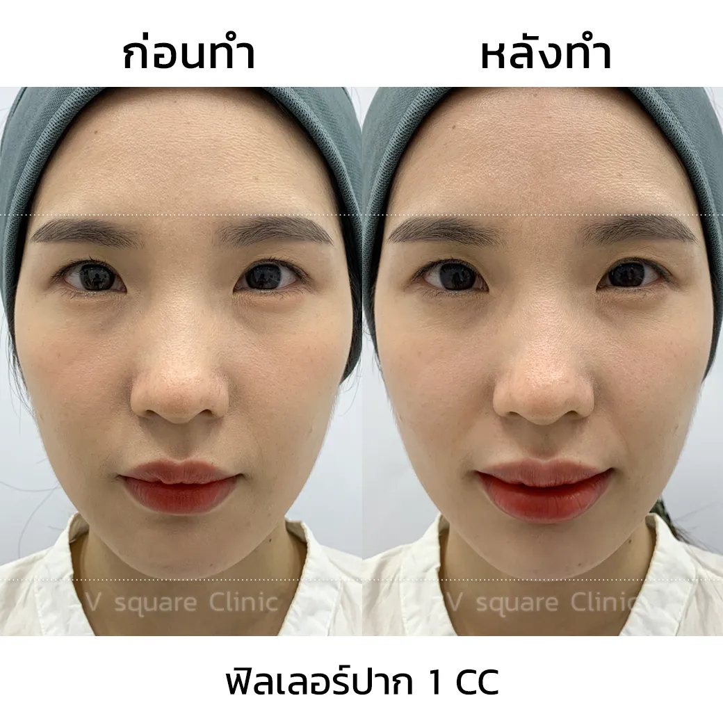 รีวิวฉีดปากเกาหลี cc_10