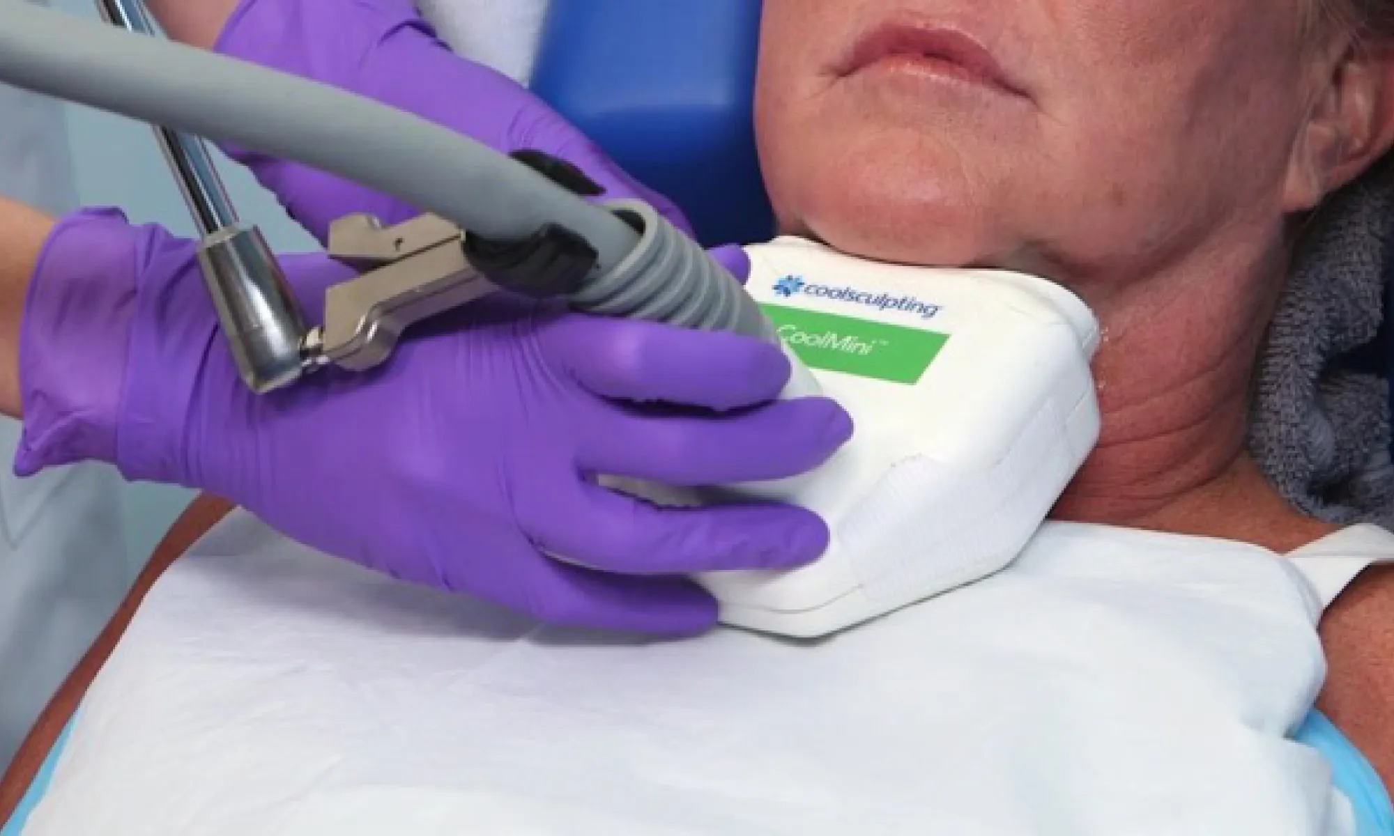 Coolsculpting-เหนียง