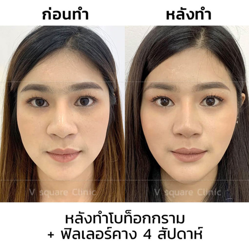 วิธีลดแก้ม ใน 1 อาทิตย์ แบบเห็นผลเร่งด่วน ปลอดภัย มีวิธีไหนบ้าง ? วิธีลดแก้ม ใน 1 อาทิตย์ แบบเห็นผลเร่งด่วน ปลอดภัย มีวิธีไหนบ้าง ?