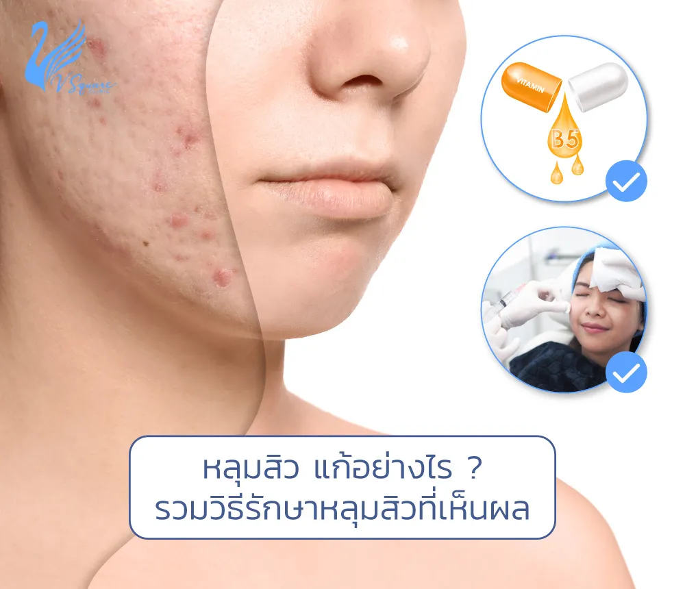 หลุมสิว คืออะไร ? หายได้ไหม ? รวมวิธีรักษาด้วยตัวเอง และวิธีทางการแพทย์ หลุมสิว คืออะไร ? หายได้ไหม ? รวมวิธีรักษาด้วยตัวเอง และวิธีทางการแพทย์